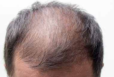 ERKEKLERDE ANDROGENETİK ALOPESİ TEDAVİSİNDE MAJİSTRAL ÇÖZÜM